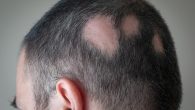 There are numerous ways to categorize hair loss. One must first examine the scalp to determine if the hair loss is due to the physical destruction and loss of hair […]