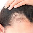 Finasteride is a drug that’s popularly known for its use as a treatment for hair loss in men, but what about women? In this post, I’ll dive introduce finasteride and […]