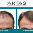 Hair loss affects everyone differently, and the decision whether to have a hair transplant procedure can be a very personal one. While there are many different factors that can affect […]