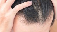 Shedding and hair loss are common conditions faced by men and women alike. They can be caused by a myriad of factors, and diffuse thinning is no different. In this […]
