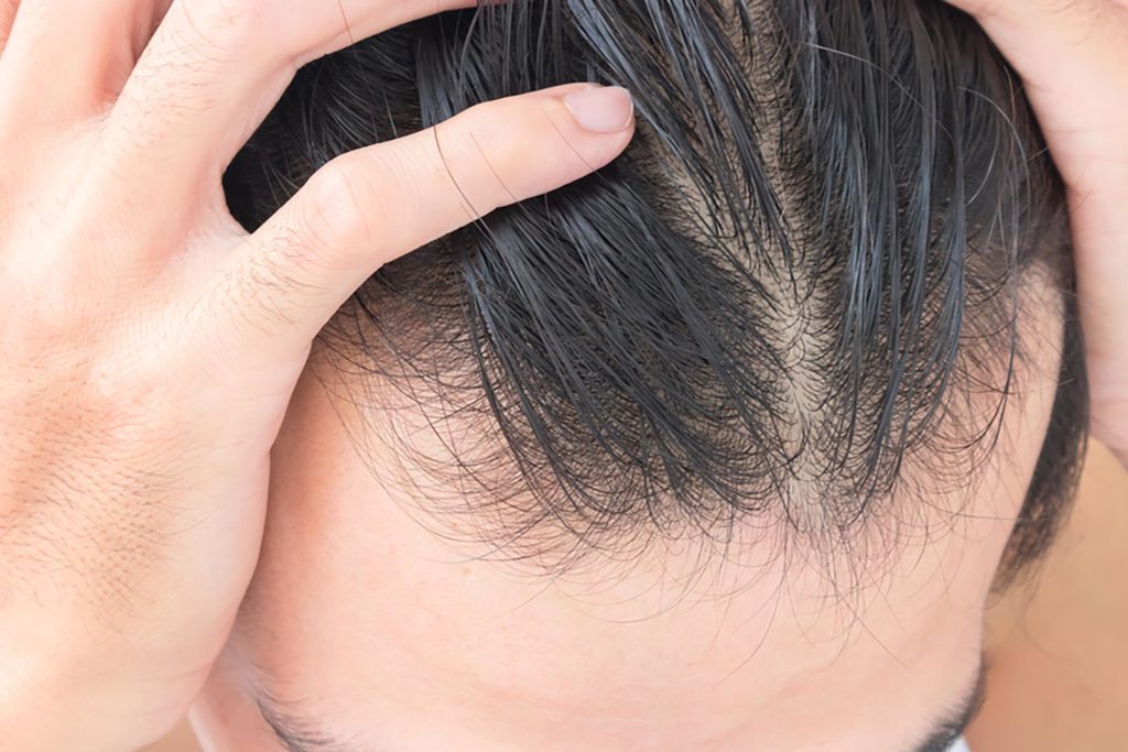 what-vitamins-are-good-for-hair-growth-and-reduce-hair-loss