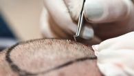 If you are considering a hair transplant, you may already know that you will need a specific number of hair grafts transplanted into the bald or thin areas of your […]