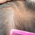 Thinning hair is the result of a large variety of factors, many of which may not be readily apparent. While many men and women experience hair loss as a result […]