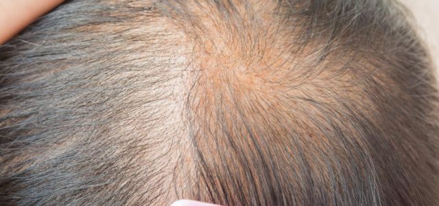 Thinning hair is the result of a large variety of factors, many of which may not be readily apparent. While many men and women experience hair loss as a result […]
