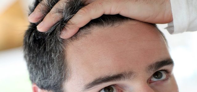 We think you’ll agree that with the lure of regaining hairlines, getting self confidence back or even not going bald, hair transplantation has become a very popular procedure. Not to […]