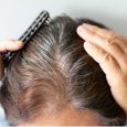 If you have bald relatives or even those with severely receding hairlines, it is very likely you may have to deal with hair loss as you get older. You may […]