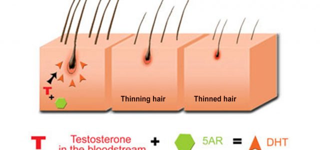 Hair Loss And DHT Most people assume that hair loss in men is caused by excessively high testosterone levels. However, this is scientifically incorrect. Research has conclusively shown that balding […]