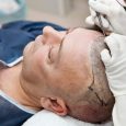 It’s extremely important to keep in mind that hair restoration is a medical art. Medical art combines medical knowledge, mastery of current surgical skills and techniques as well as a […]